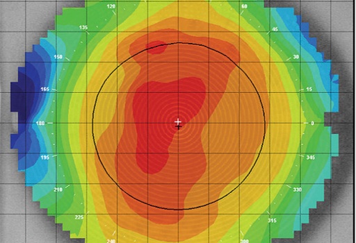 Services Advance Tech Corneal Map | Bellingham Optometrist | Eye Doctor | Glasses | Mount Baker Vision Center